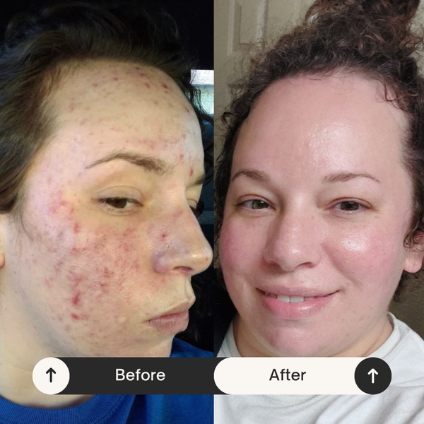 Cystic Acne, Rosacea & Nutrient Deficiencies