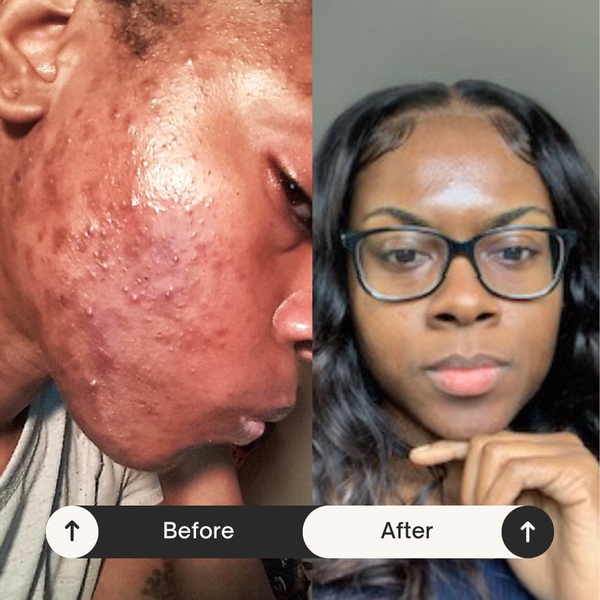 PMOS-Related Acne & Hyperpigmentation