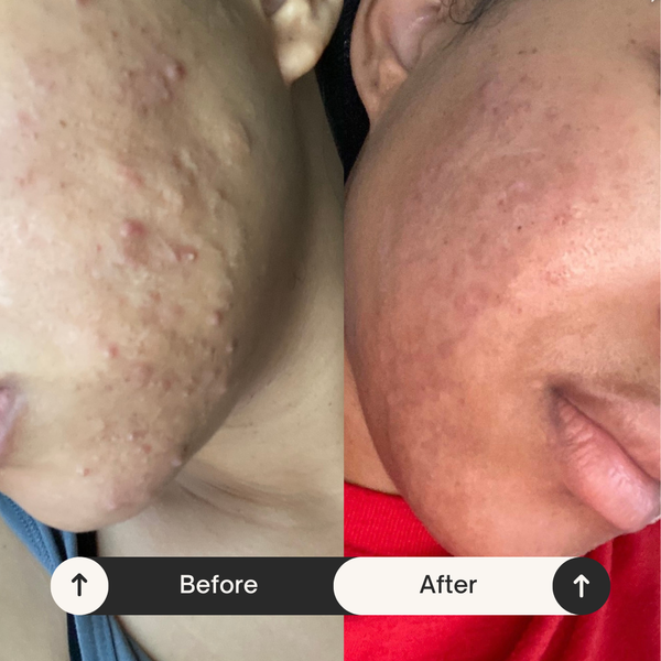 Hormonal Cystic Acne