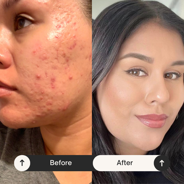 Hormonal Cystic Acne