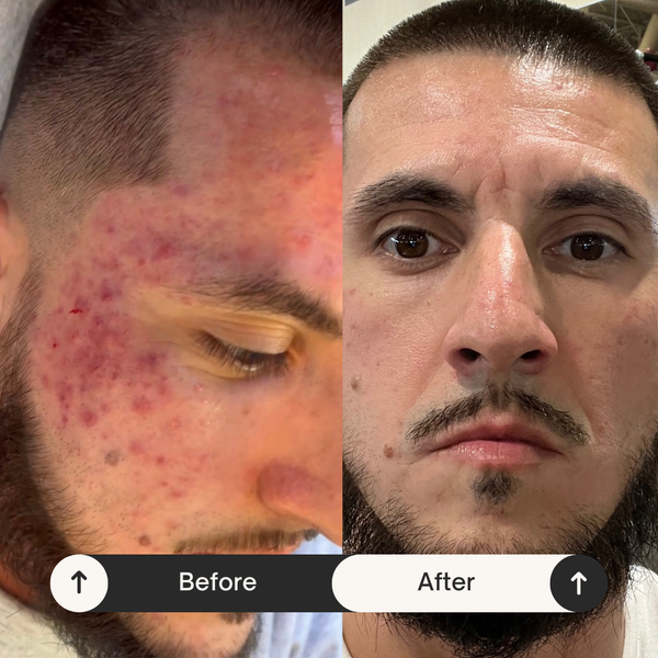 Cystic Acne