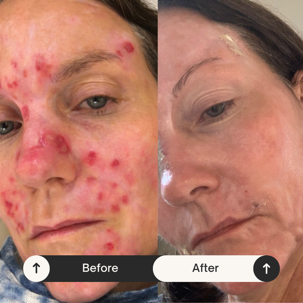 Lupus & Lyme Disease Flare-Ups